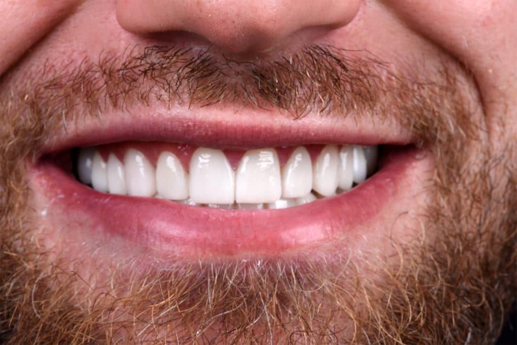 Couronne dentaire VIP Smile pour vos Facettes Implants et Soins dentaires