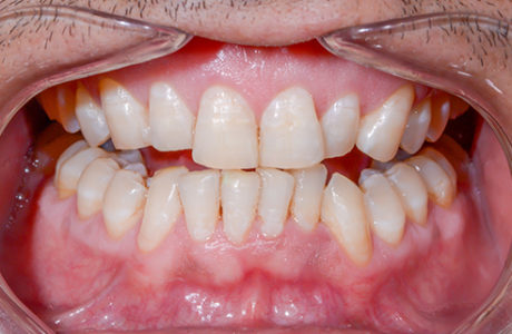 Sourire Facette Implant 6