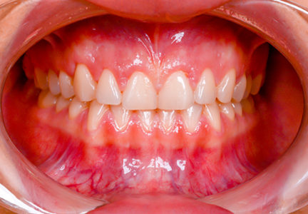 Facette Implant dentaire 10
