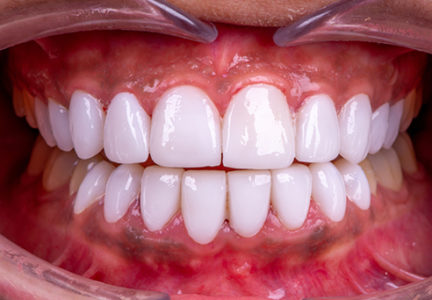 Facette Implant dentaire 7