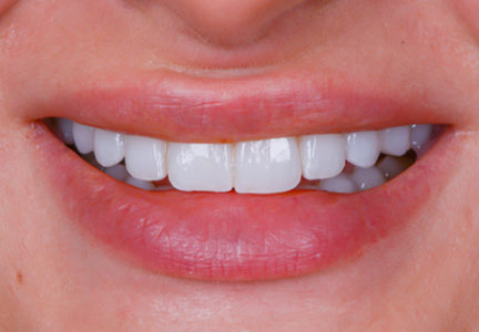 Facette Implant dentaire 2