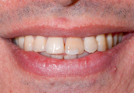 Facette Implant dentaire 4
