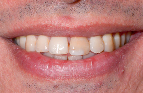 Facette Implant dentaire 4