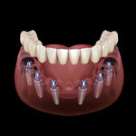 Facette Implant 2