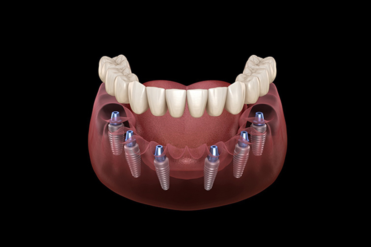 Facette Implant 2