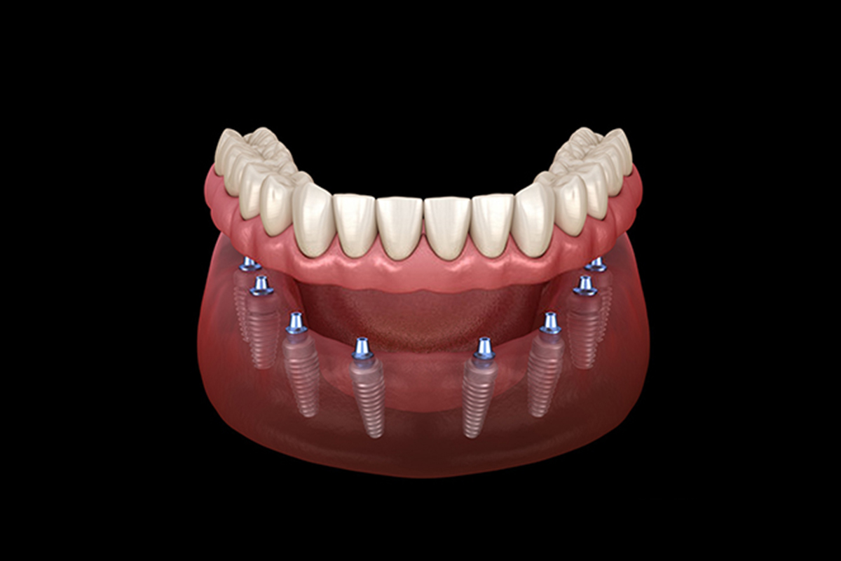 Facette Implant 1