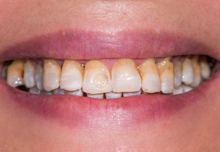 Facette Implant Soins dentaires 10