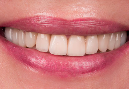Facette Implant Soins dentaires 9