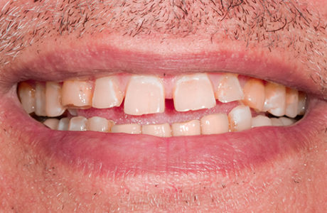 Facette Implant Soins dentaires 8