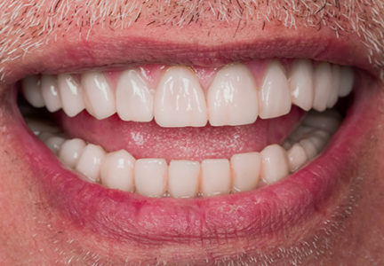 Facette Implant Soins dentaires 7