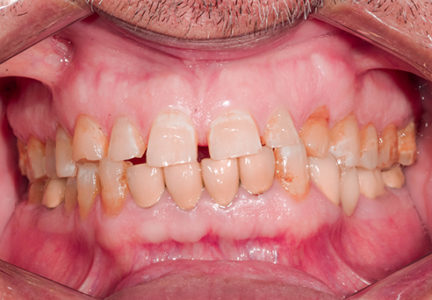 Facette Implant Soins dentaires 6