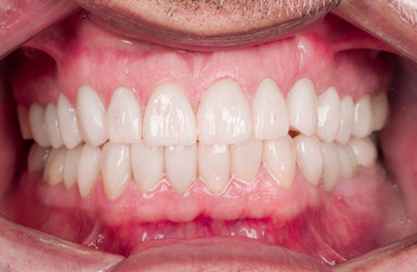 Facette Implant Soins dentaires 5