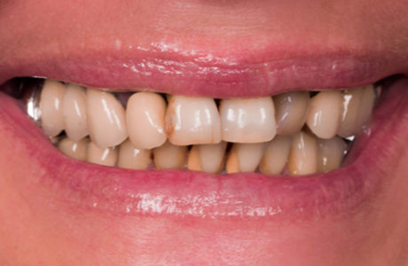 Facette Implant Soins dentaires 4