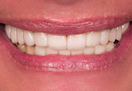 Facette Implant Soins dentaires 3