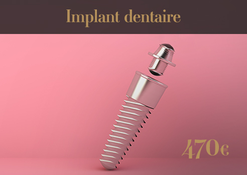 implant dentaire 2